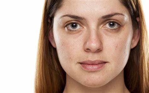 Skin Dullness